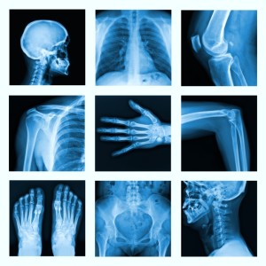 osteoporosis-treatment-xray-collage